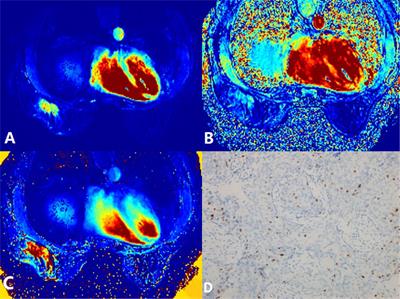 Correlation of DCE-MRI Perfusion Parameters and Molecular Biology of Breast Infiltrating Ductal Carcinoma